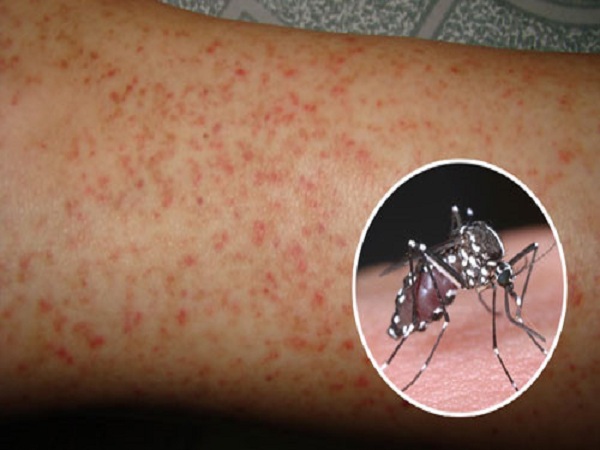 Dấu hiệu bệnh sốt xuất huyết
