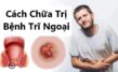 Cách chữa trị bệnh trĩ ngoại tận gốc, không tái phát