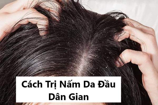 Cách trị nấm da đầu dân gian hiệu quả không cần thuốc