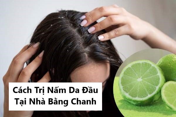 5 cách trị nấm da đầu tại nhà bằng chanh bạn nên thử