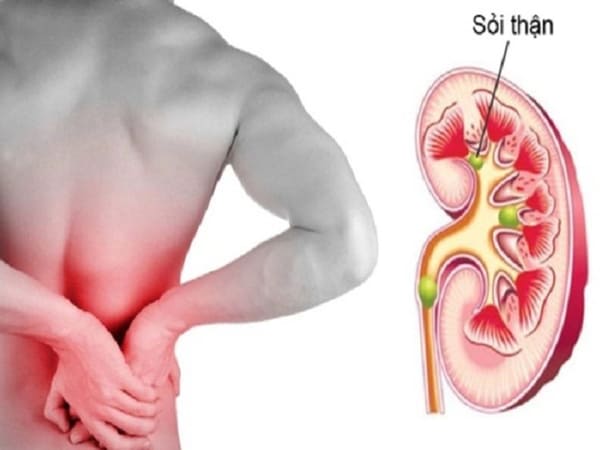 Tìm hiểu về bệnh sỏi thận